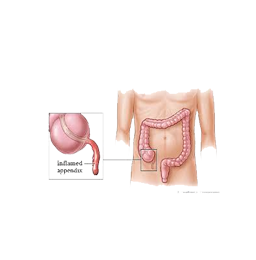 Appendix Surgery India