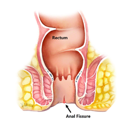 Appendix Surgery India