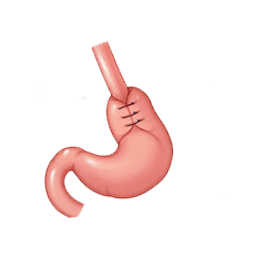 Appendix Surgery India