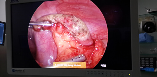 Appendix Surgery India